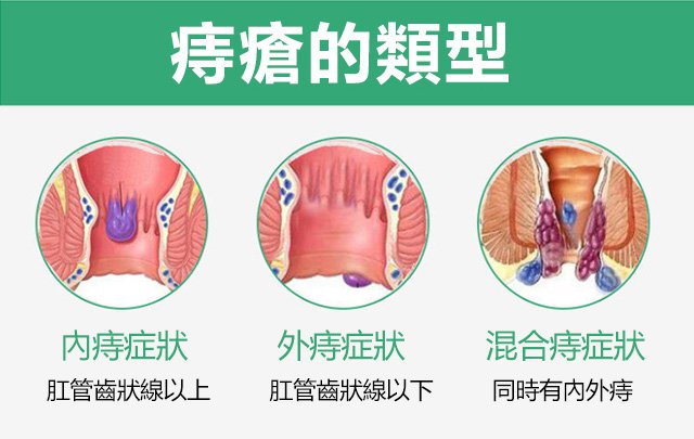 1624594163530432.jpg 1624594163530432 痔瘡噴劑