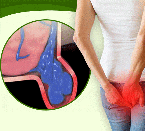 EELHOE天然草藥噴霧舒緩腫脹痔| 樂活優品