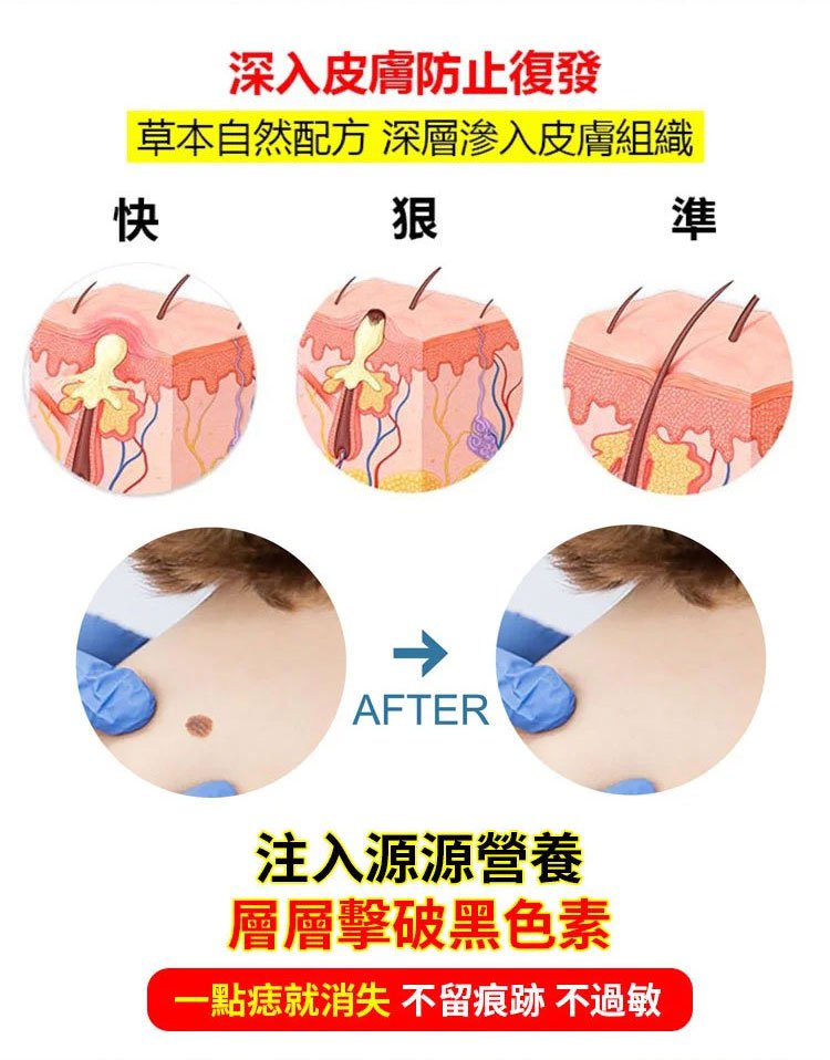 雲南本草克疣膏 20 0b28212f7d56ceda31377344cef5ef81 雲南本草克疣膏