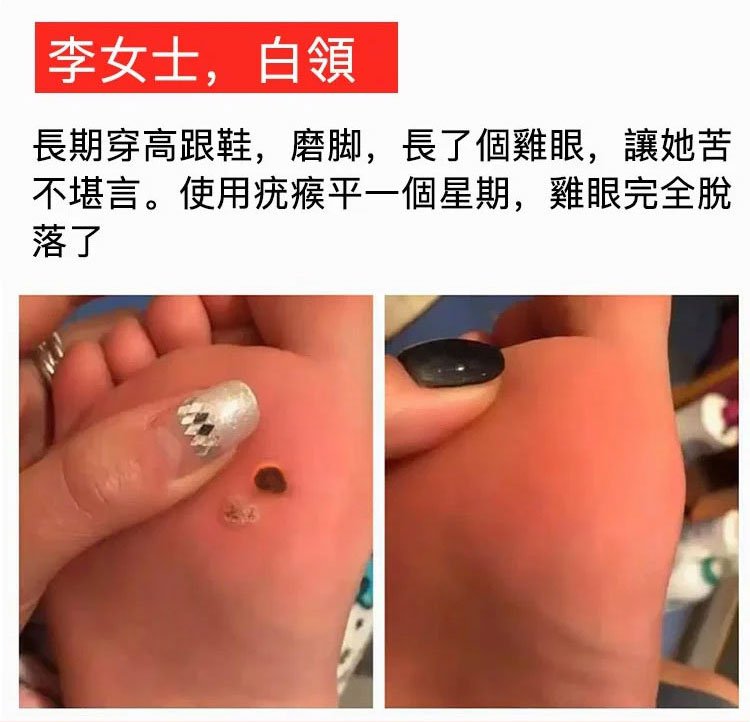 雲南本草克疣膏 31 164849c89ec21363747d4c3e76562ab4 雲南本草克疣膏