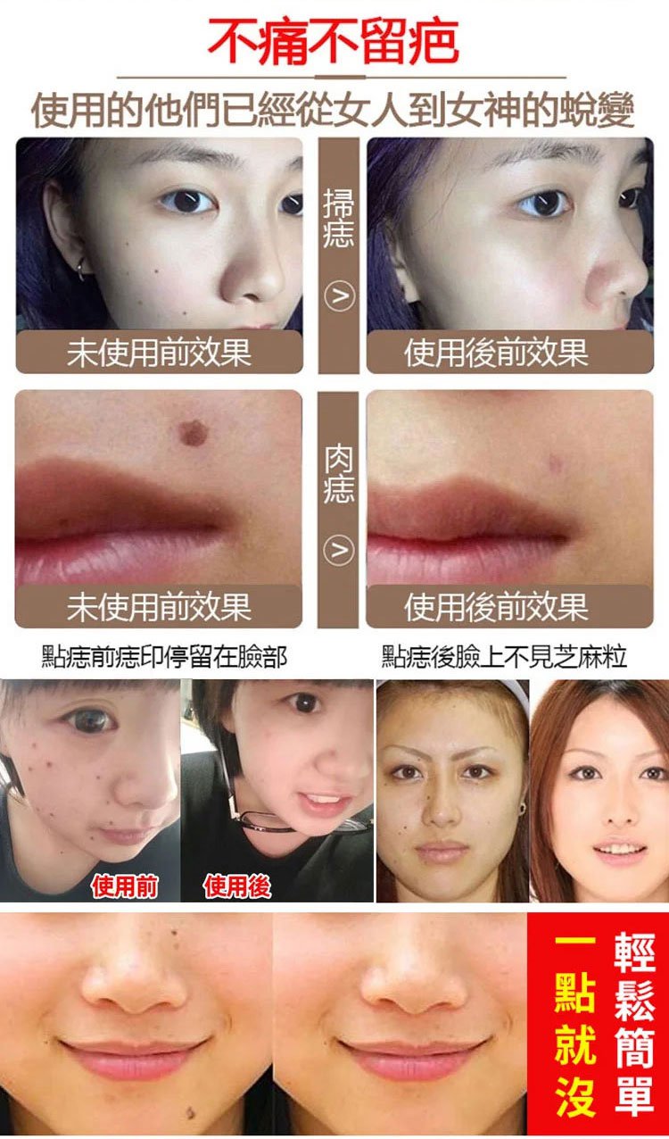 雲南本草克疣膏 23 1f15efb00e389deca1e0d46c81d0ab99 雲南本草克疣膏