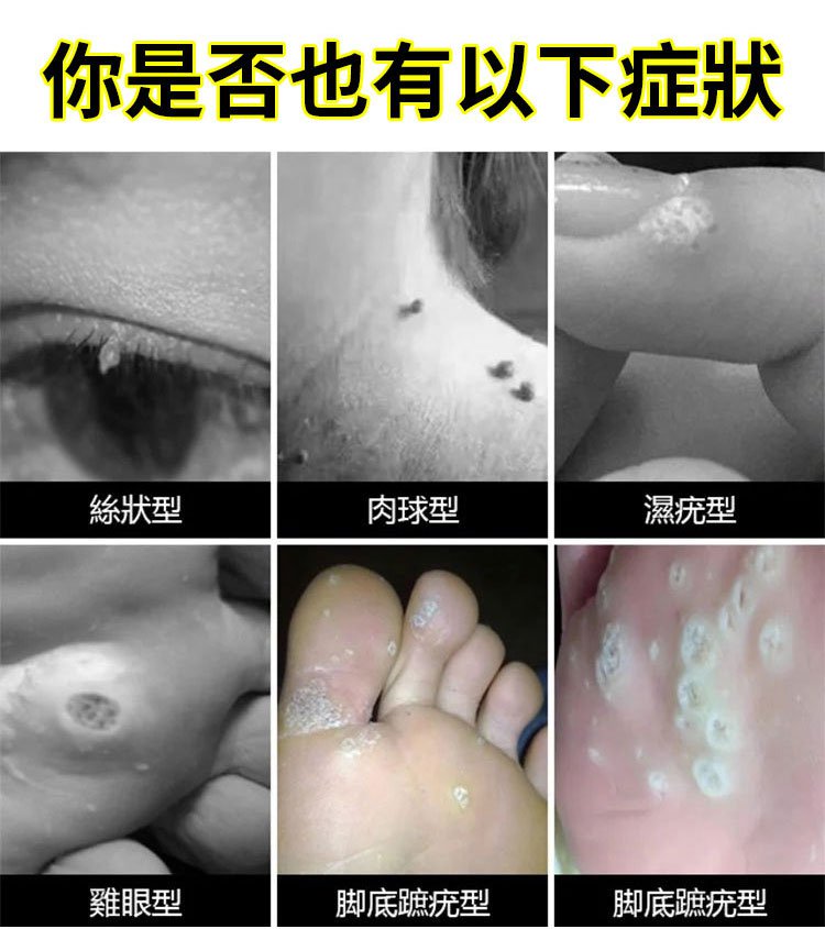 雲南本草克疣膏 4 99090e12c50bfcc037106ab56c1ca475 雲南本草克疣膏