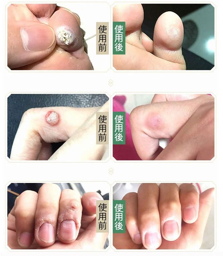 雲南本草克疣膏 30 a45fbef313bdf6f6e61ec5d86a7d4528 雲南本草克疣膏