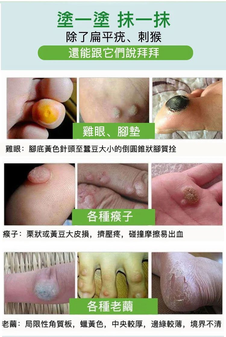 雲南本草克疣膏 28 c7b2d3d7aad2b1f9d86f7f75b144ac00 雲南本草克疣膏