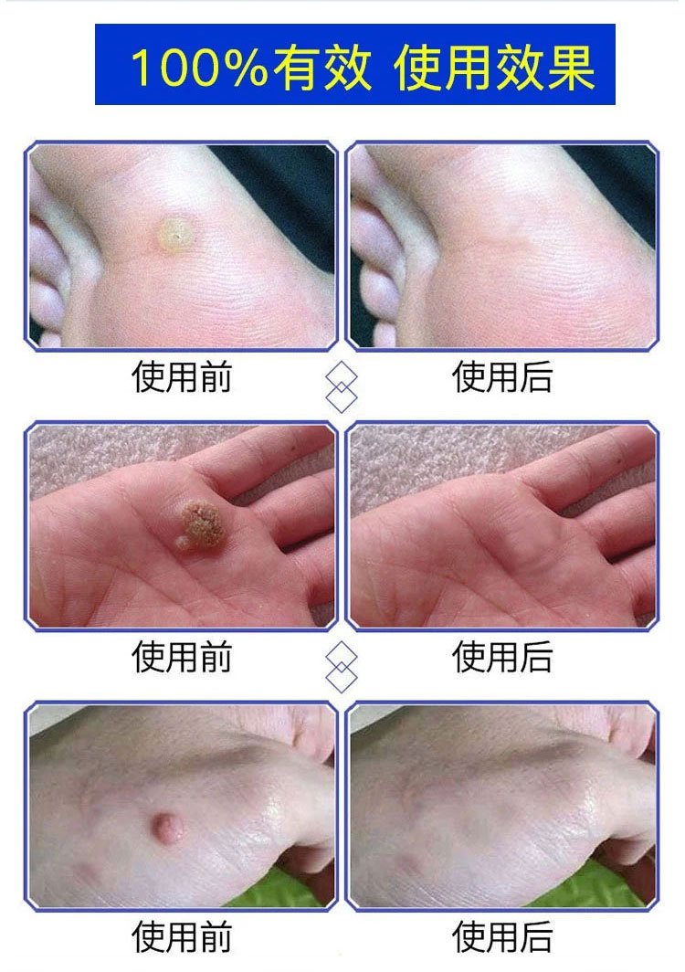 雲南本草克疣膏 29 e494130866e6c2c15c7beed22c9cc37e 雲南本草克疣膏