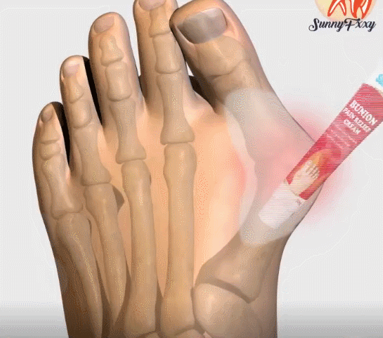 足跟舒筋活絡腳痛膏 24 e6bf229ab3c09734032e94c637aa16e1 足跟舒筋活絡腳痛膏